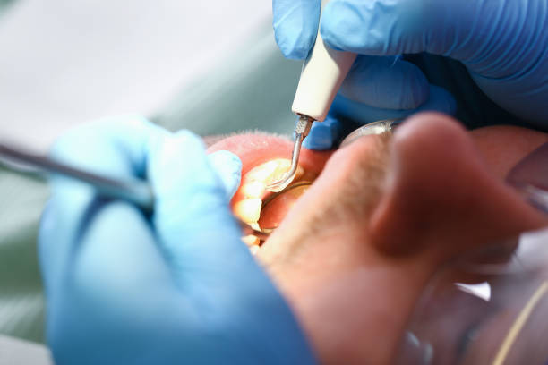 Best Emergency Treatment for Dental Infections or Abscesses in Bel Air, MD